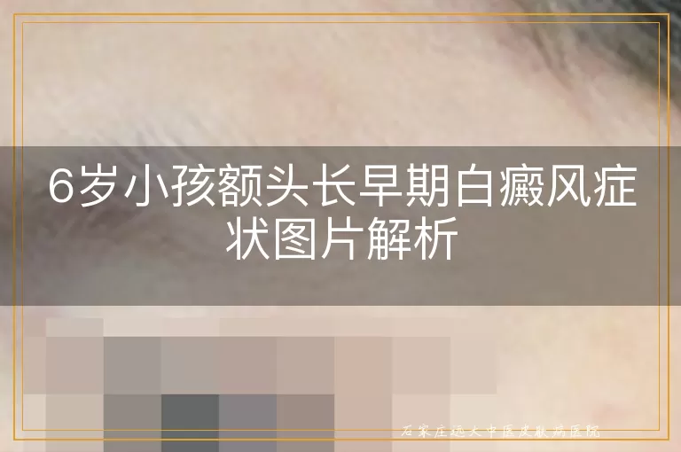 6岁小孩额头长早期白癜风症状图片解析