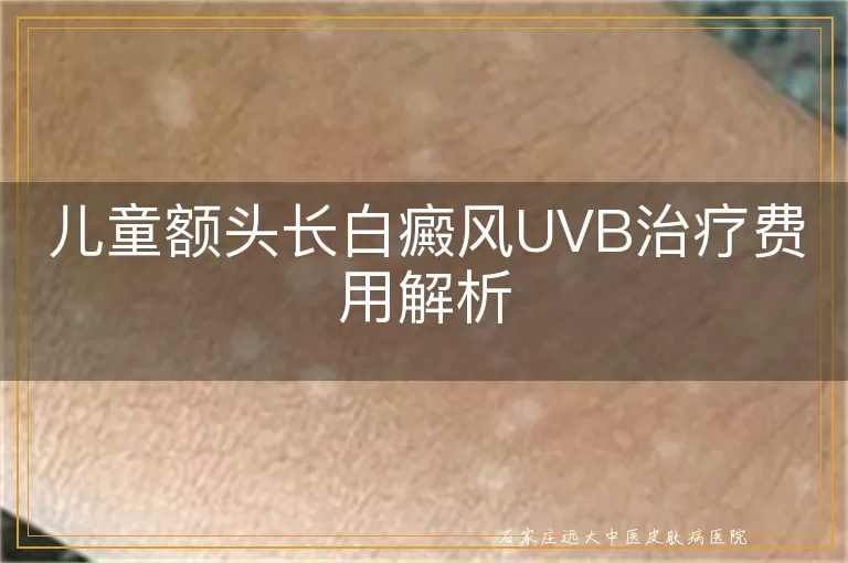 儿童额头长白癜风UVB治疗费用解析