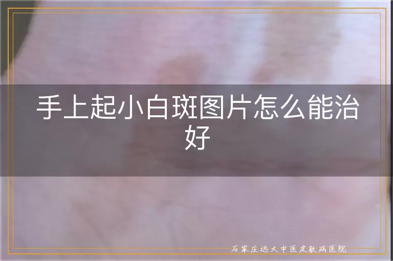 手上起小白斑图片怎么能治好