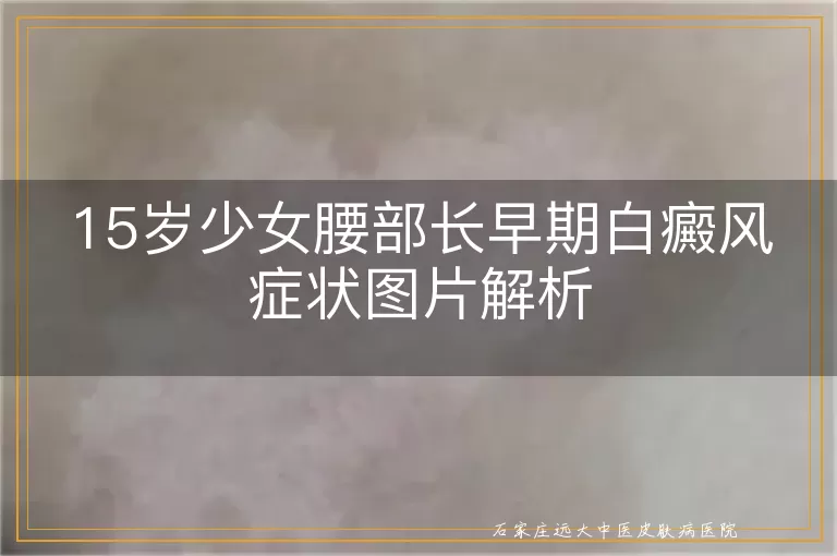 15岁少女腰部长早期白癜风症状图片解析
