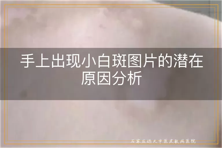 手上出现小白斑图片的潜在原因分析