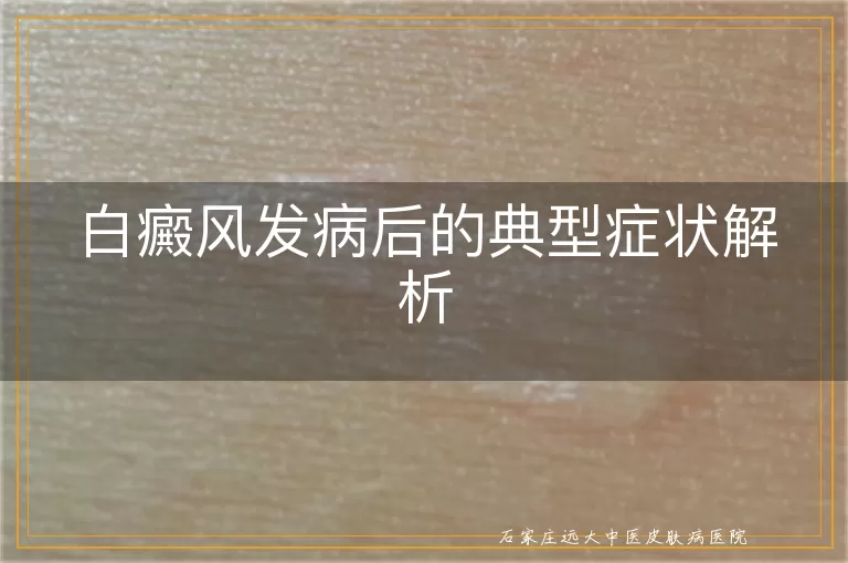白癜风发病后的典型症状解析