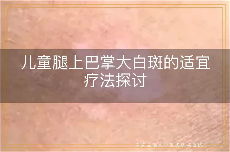 儿童腿上巴掌大白斑的适宜疗法探讨