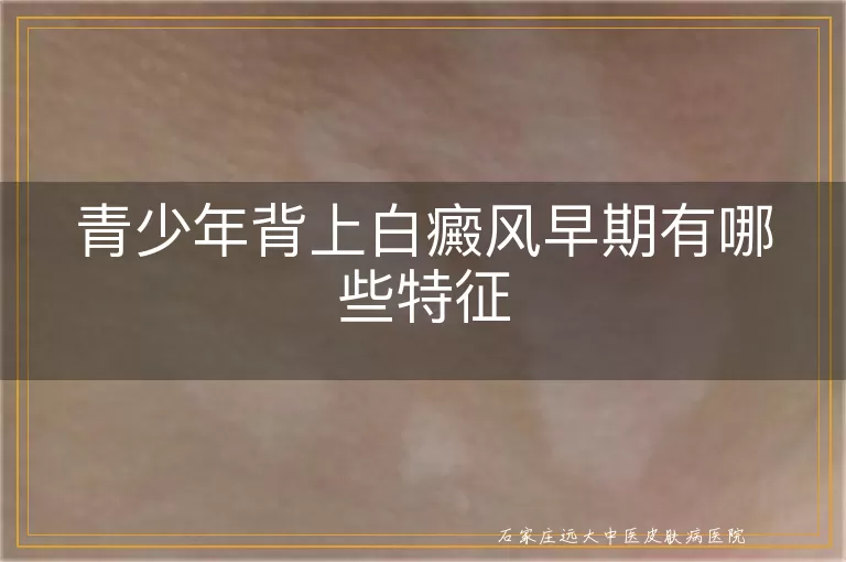 青少年背上白癜风早期有哪些特征