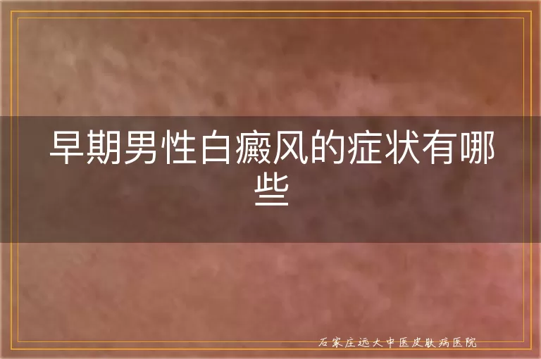 早期男性白癜风的症状有哪些