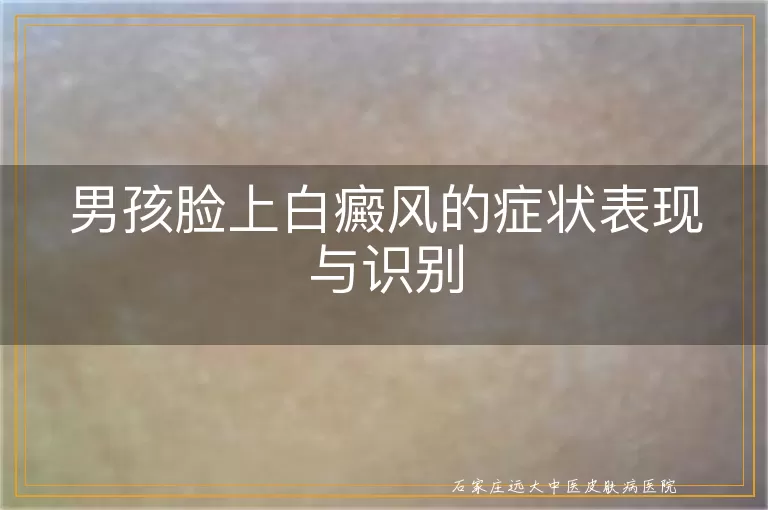 男孩脸上白癜风的症状表现与识别