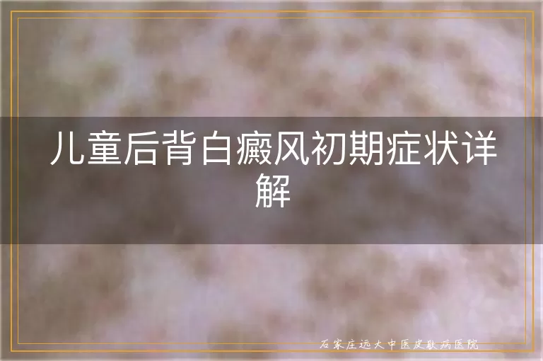 儿童后背白癜风初期症状详解