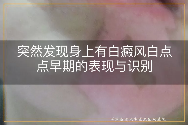 突然发现身上有白癜风白点点早期的表现与识别