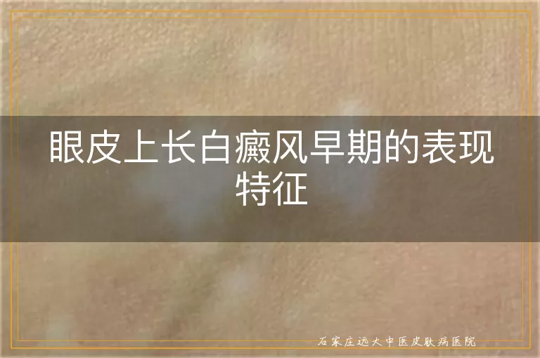 眼皮上长白癜风早期的表现特征