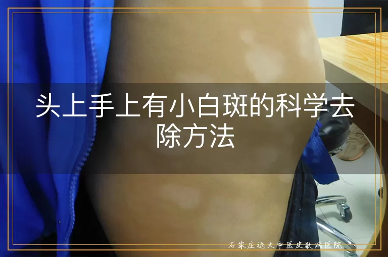 头上手上有小白斑的科学去除方法