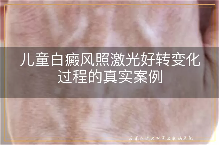 儿童白癜风照激光好转变化过程的真实案例