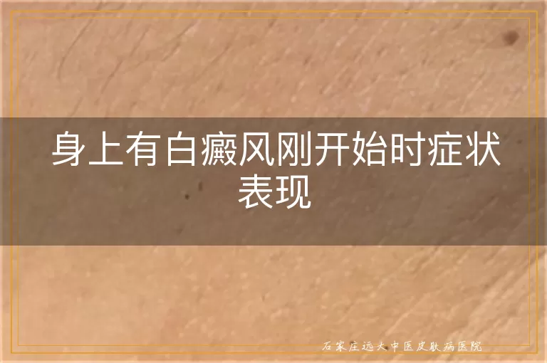 身上有白癜风刚开始时症状表现