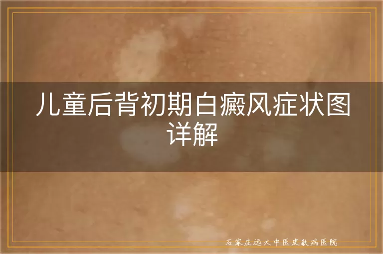 儿童后背初期白癜风症状图详解