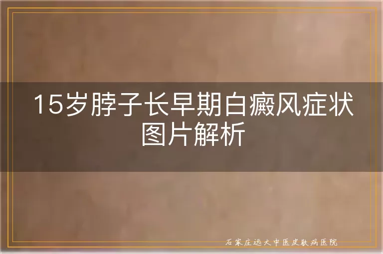 15岁脖子长早期白癜风症状图片解析