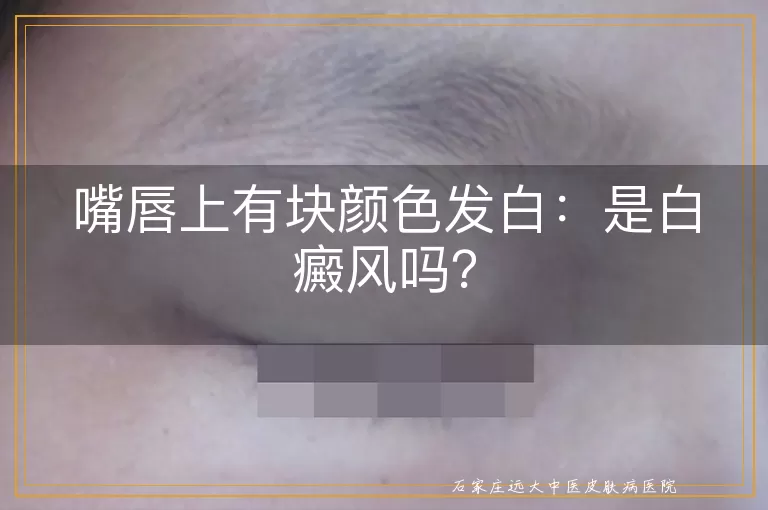 嘴唇上有块颜色发白：是白癜风吗？