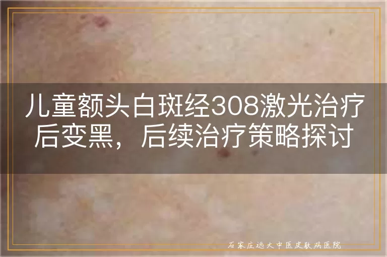 儿童额头白斑经308激光治疗后变黑，后续治疗策略探讨