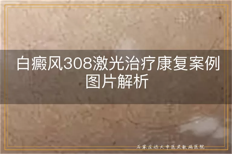 白癜风308激光治疗康复案例图片解析
