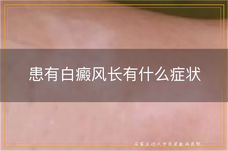 患有白癜风长有什么症状