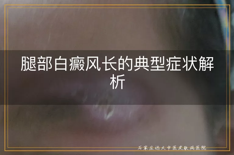 腿部白癜风长的典型症状解析
