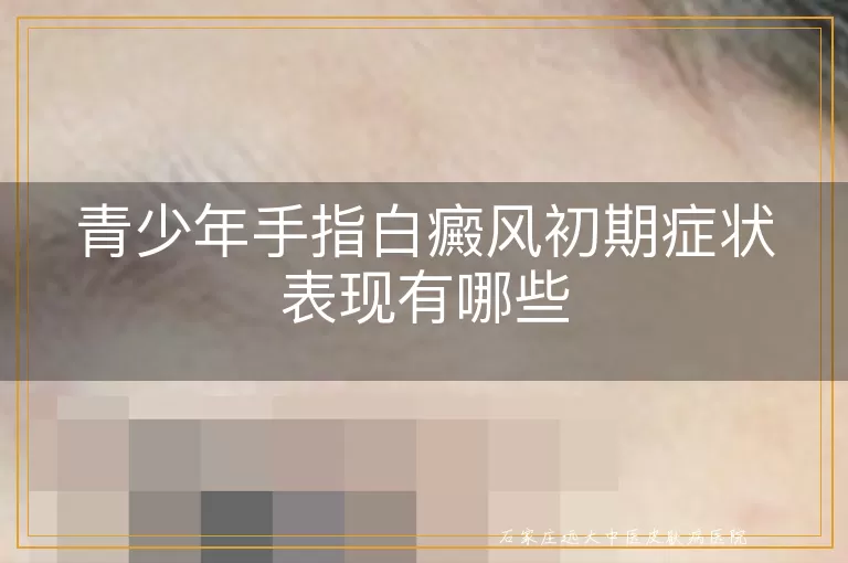 青少年手指白癜风初期症状表现有哪些