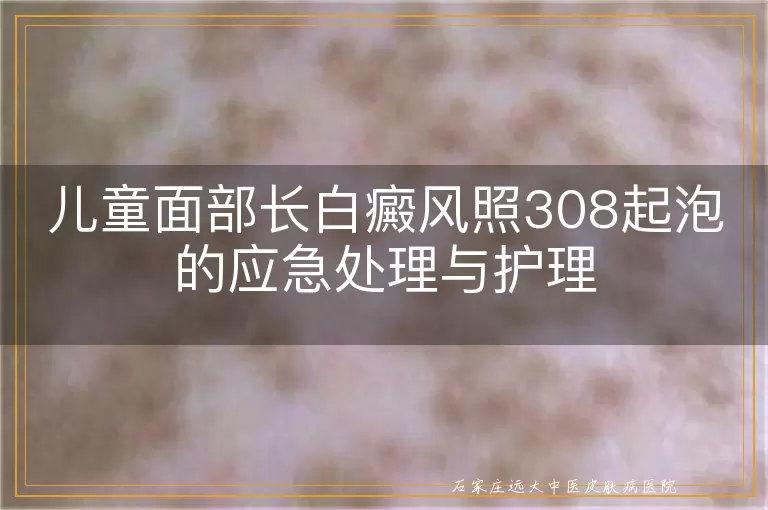 儿童面部长白癜风照308起泡的应急处理与护理
