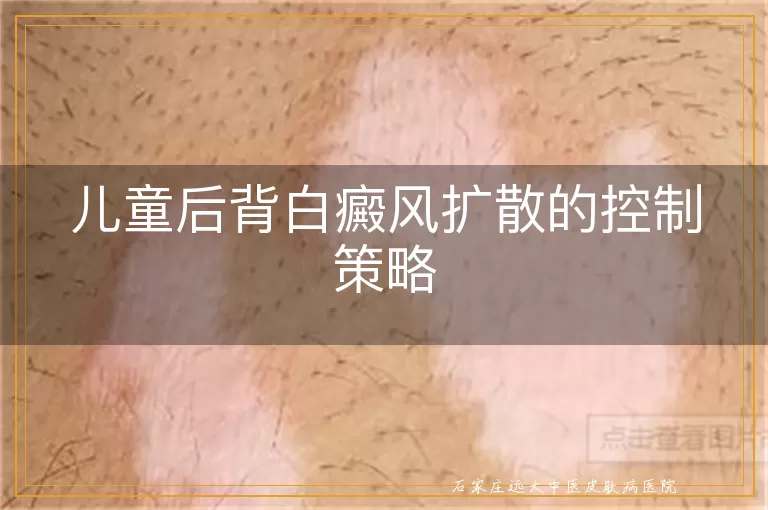 儿童后背白癜风扩散的控制策略