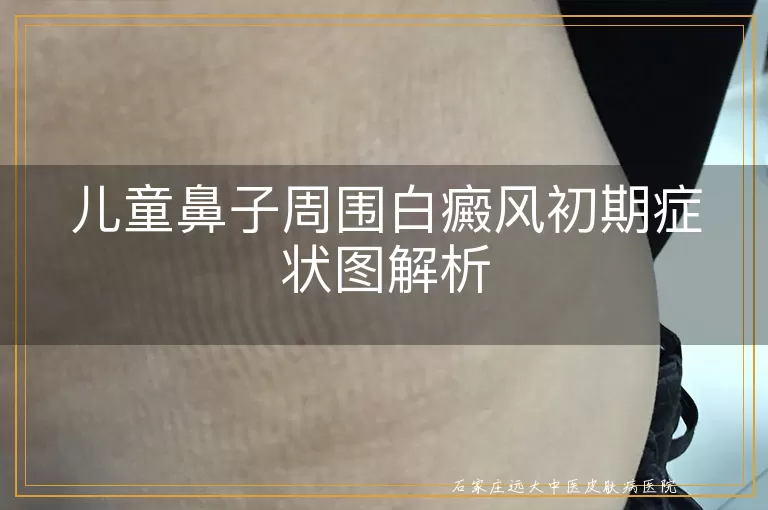 儿童鼻子周围白癜风初期症状图解析