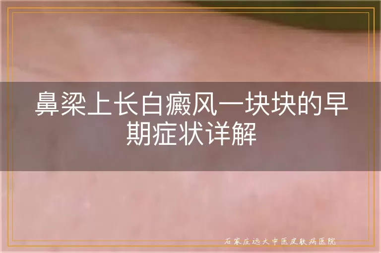 鼻梁上长白癜风一块块的早期症状详解
