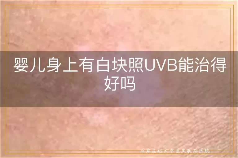 婴儿身上有白块照UVB能治得好吗