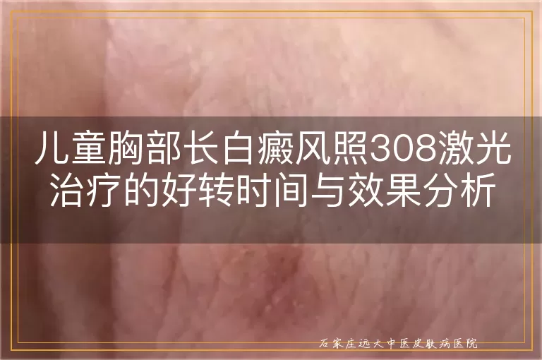 儿童胸部长白癜风照308激光治疗的好转时间与效果分析