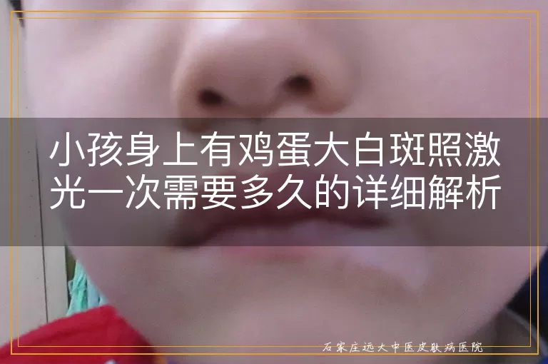小孩身上有鸡蛋大白斑照激光一次需要多久的详细解析