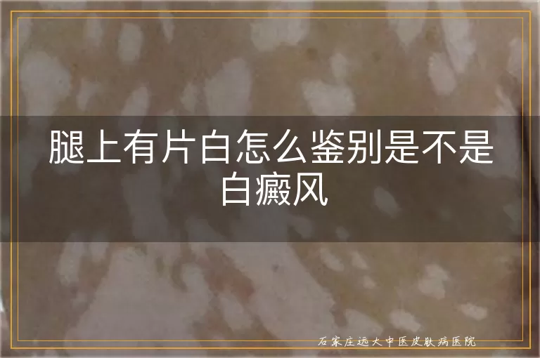 腿上有片白怎么鉴别是不是白癜风