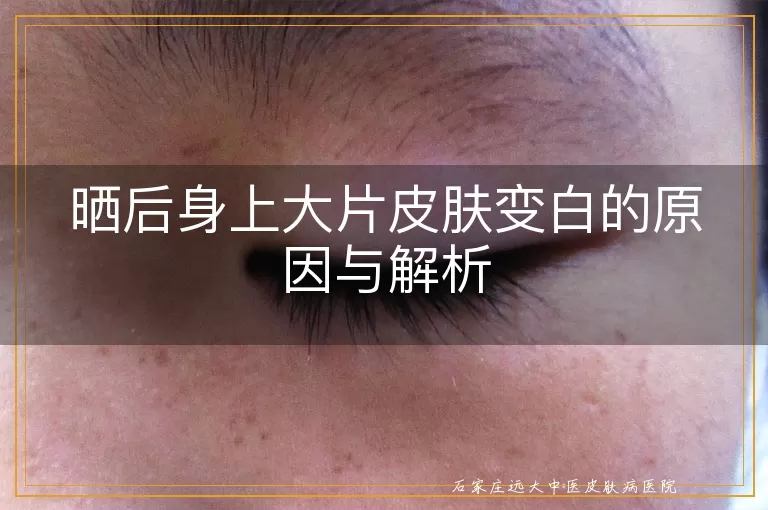晒后身上大片皮肤变白的原因与解析