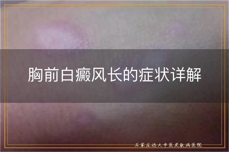 胸前白癜风长的症状详解