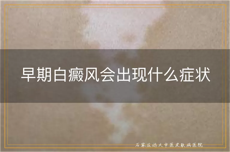 早期白癜风会出现什么症状