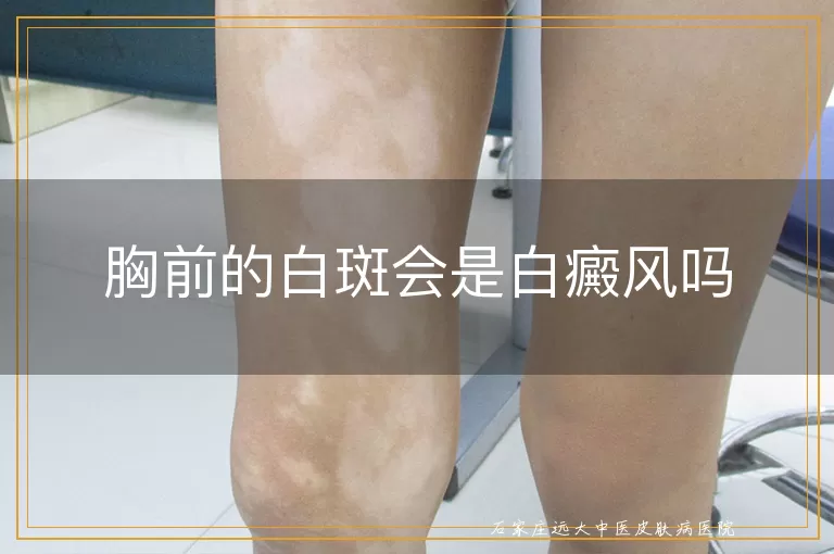胸前的白斑会是白癜风吗