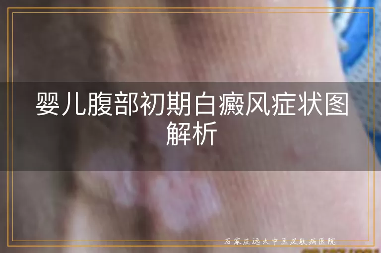 婴儿腹部初期白癜风症状图解析