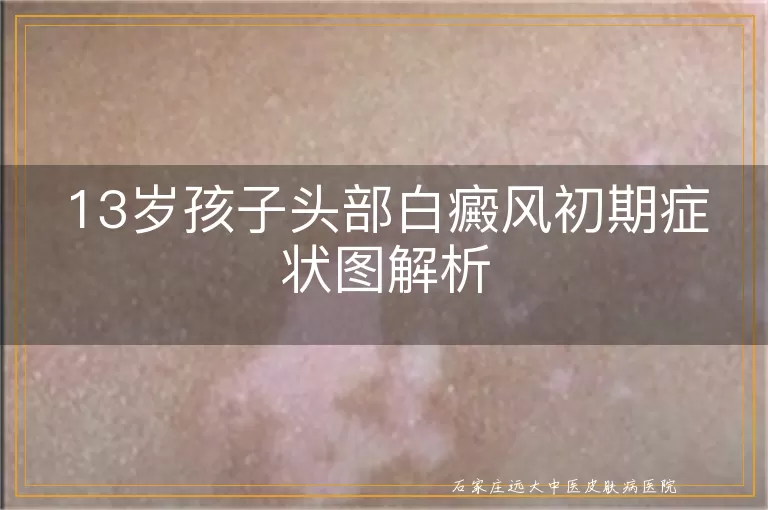 13岁孩子头部白癜风初期症状图解析
