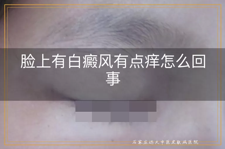 脸上有白癜风有点痒怎么回事