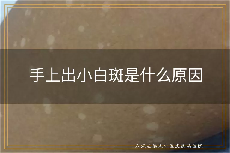 手上出小白斑是什么原因