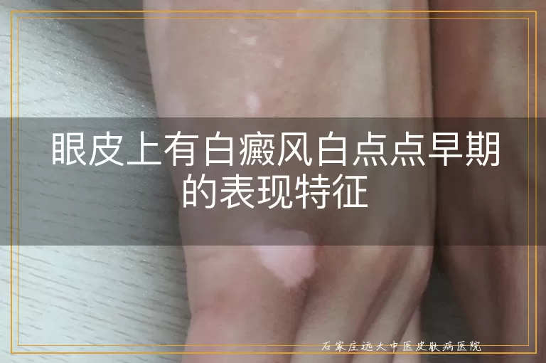 眼皮上有白癜风白点点早期的表现特征