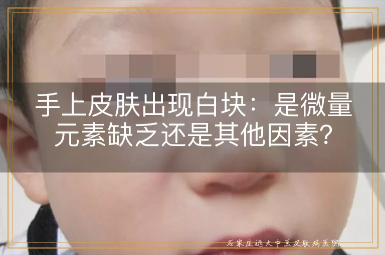 手上皮肤出现白块：是微量元素缺乏还是其他因素？
