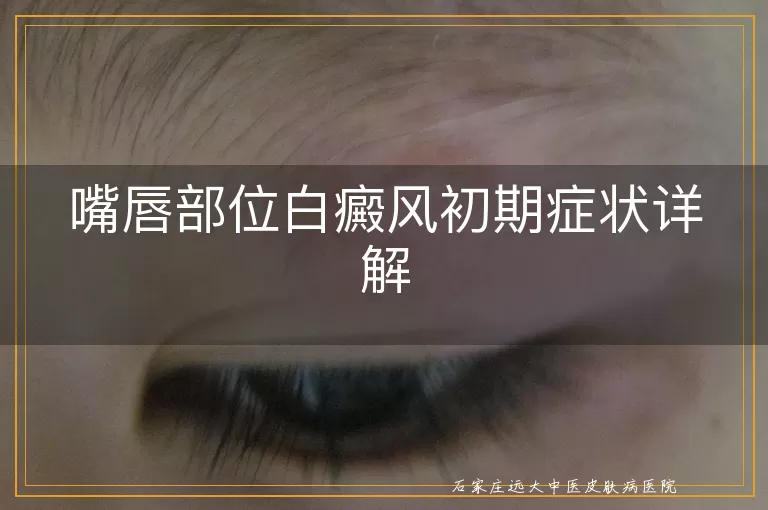 嘴唇部位白癜风初期症状详解