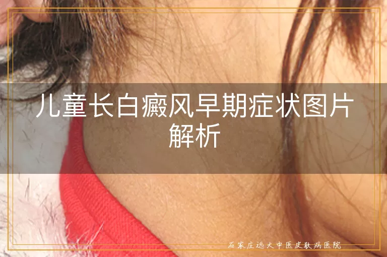 儿童长白癜风早期症状图片解析
