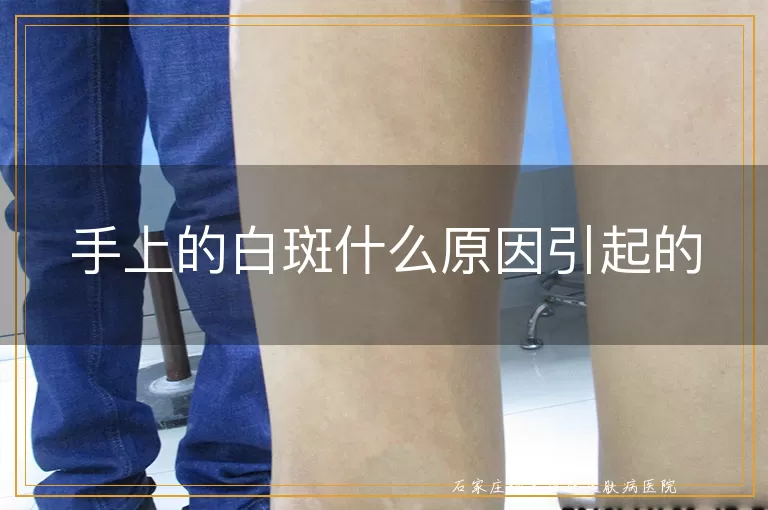 手上的白斑什么原因引起的