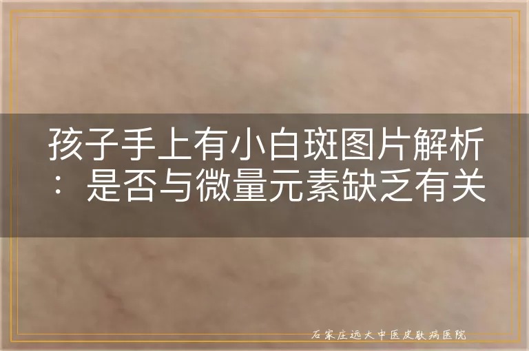 孩子手上有小白斑图片解析：是否与微量元素缺乏有关？
