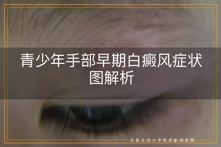 青少年手部早期白癜风症状图解析