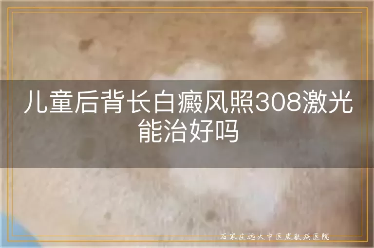 儿童后背长白癜风照308激光能治好吗