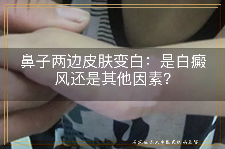 鼻子两边皮肤变白：是白癜风还是其他因素？