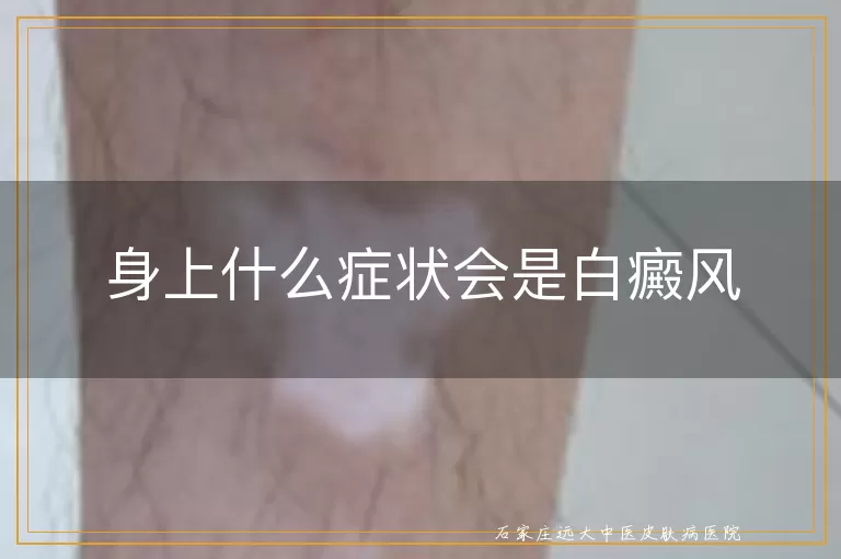 身上什么症状会是白癜风
